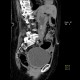 Choledocholithiasis, bile duct stones: CT - Computed tomography